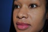 33 year-old female Rhinoplasty