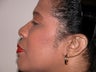 Rhinoplasty