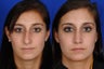 Open Rhinoplasty