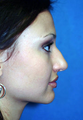 Rhinoplasty