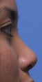 Non Surgical Rhinoplasty