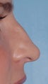 Non Surgical Rhinoplasty