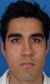 Male Rhinoplasty