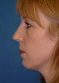 Rhinoplasty