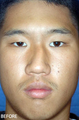 Rhinoplasty