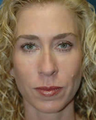 Rhinoplasty
