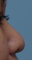 Non Surgical Rhinoplasty