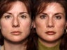 Rhinoplasty