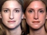 Rhinoplasty