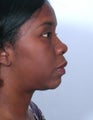 Rhinoplasty