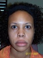 Rhinoplasty