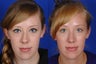 Open Rhinoplasty