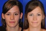 Open Rhinoplasty