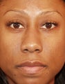 Rhinoplasty