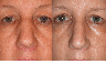 Rhinoplasty, closed technique with osteotomies