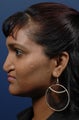Rhinoplasty for cleft lip nasal deformity