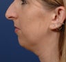 Rhinoplasty and Chin Implant