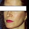 Rhinoplasty