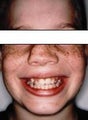 Repair congential defect with open Septorhinoplasty