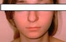 Rhinoplasty to correct dorsal hump and drooping nasal tip in 15 year old girl