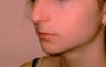 Rhinoplasty to correct dorsal hump and drooping nasal tip in 15 year old girl