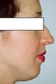 Septorhinoplasty to correct breathing difficulty and cosmetic dorsal hump deformity