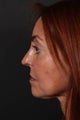 Rhinoplasty