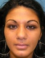 Reduction Rhinoplasty