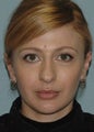 Rhinoplasty, minor neck liposuction