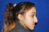 Rhinoplasty