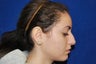 Rhinoplasty