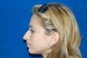 Rhinoplasty
