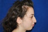 Rhinoplasty