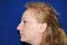Rhinoplasty