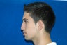 Rhinoplasty