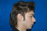 Rhinoplasty