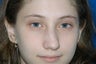 Rhinoplasty