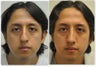 Rhinoplasty