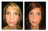 Rhinoplasty