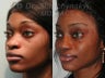 African American Rhinoplasty