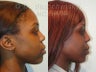 African American Rhinoplasty