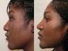 African American Rhinoplasty