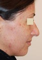 Rhinoplasty and IPL PhotoFacial, profile view