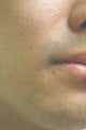 Laser Scar Removal Los Angeles