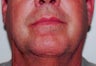 Scar Revision