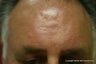 Forehead scar revision with simple excision