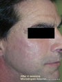 Microdroplet Silicone Acne Scar Revision