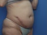 Abdominoplasty