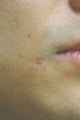 Laser Scar Removal Los Angeles
