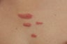 Keloid Scar Removal Los Angeles